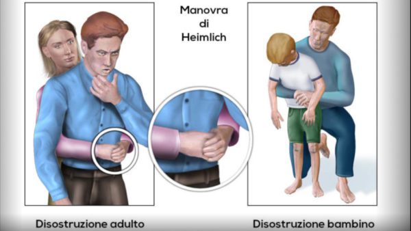 Con la manovra di Heimlich agenti di polizia salvano bimba che rischiava di soffocare: cos’è e come si pratica