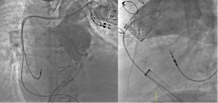 Ospedale Taormina, intervento 'valve in valve' a cardiopatico